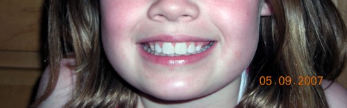 same photo of teeth now with no braces