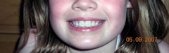 same photo of teeth now with no braces